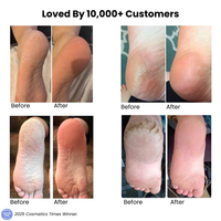 Flo-Foot Callus Remover